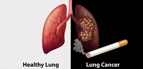 What are the risk factors for Lung Cancer? What is