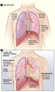 Asbestos pulmonary fibrosis